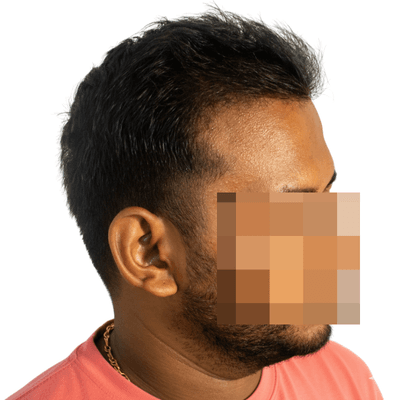 FUE hair transplant after result