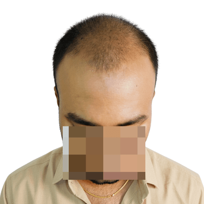 Hair transplant before result Coimbatore
