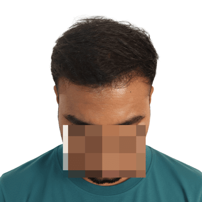 Hair transplant after result Coimbatore