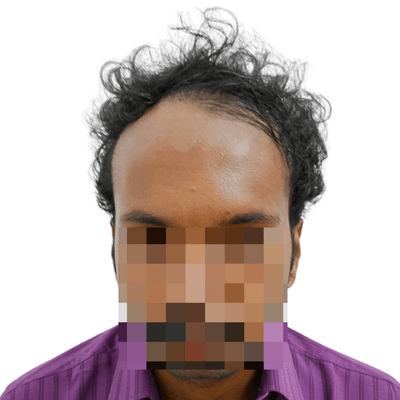 Hair transplant before result