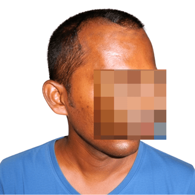 Hair restoration before result Chennai