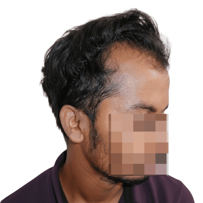 Hair loss treatment before result