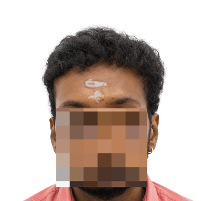 Hair transplant after result