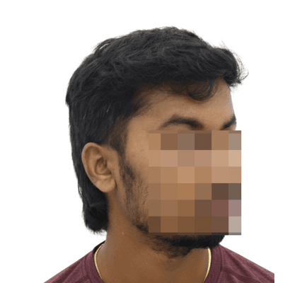 Hair loss treatment after result