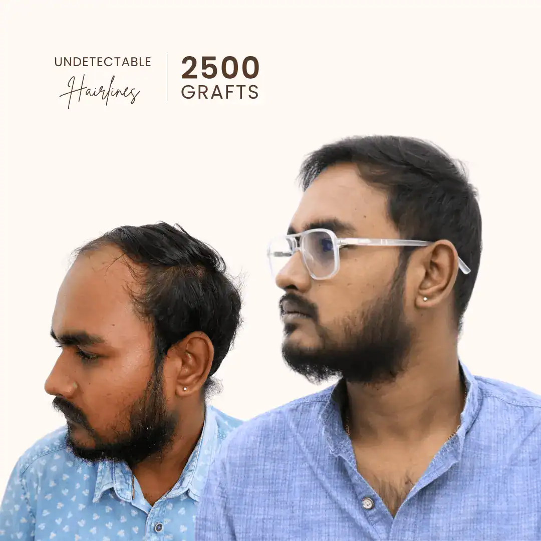 Hair transplant result Hyderabad