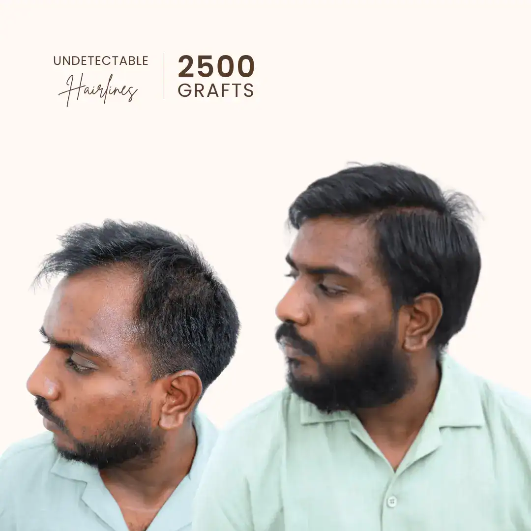 Tarun hair transplant result