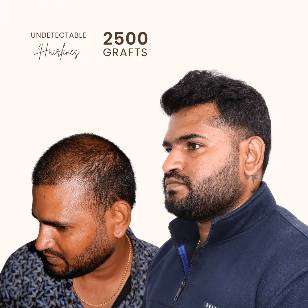 Suresh Kumar hair transplant result Bangalore