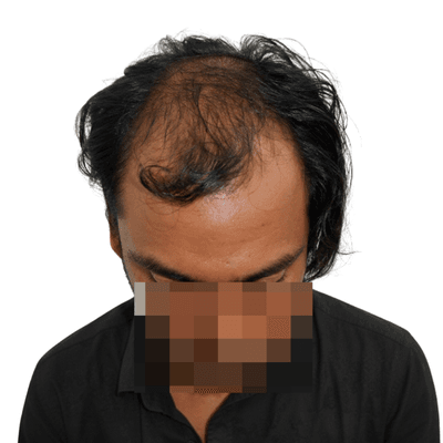 Sapphire FUE before result