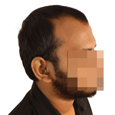 FUE hair transplant before result