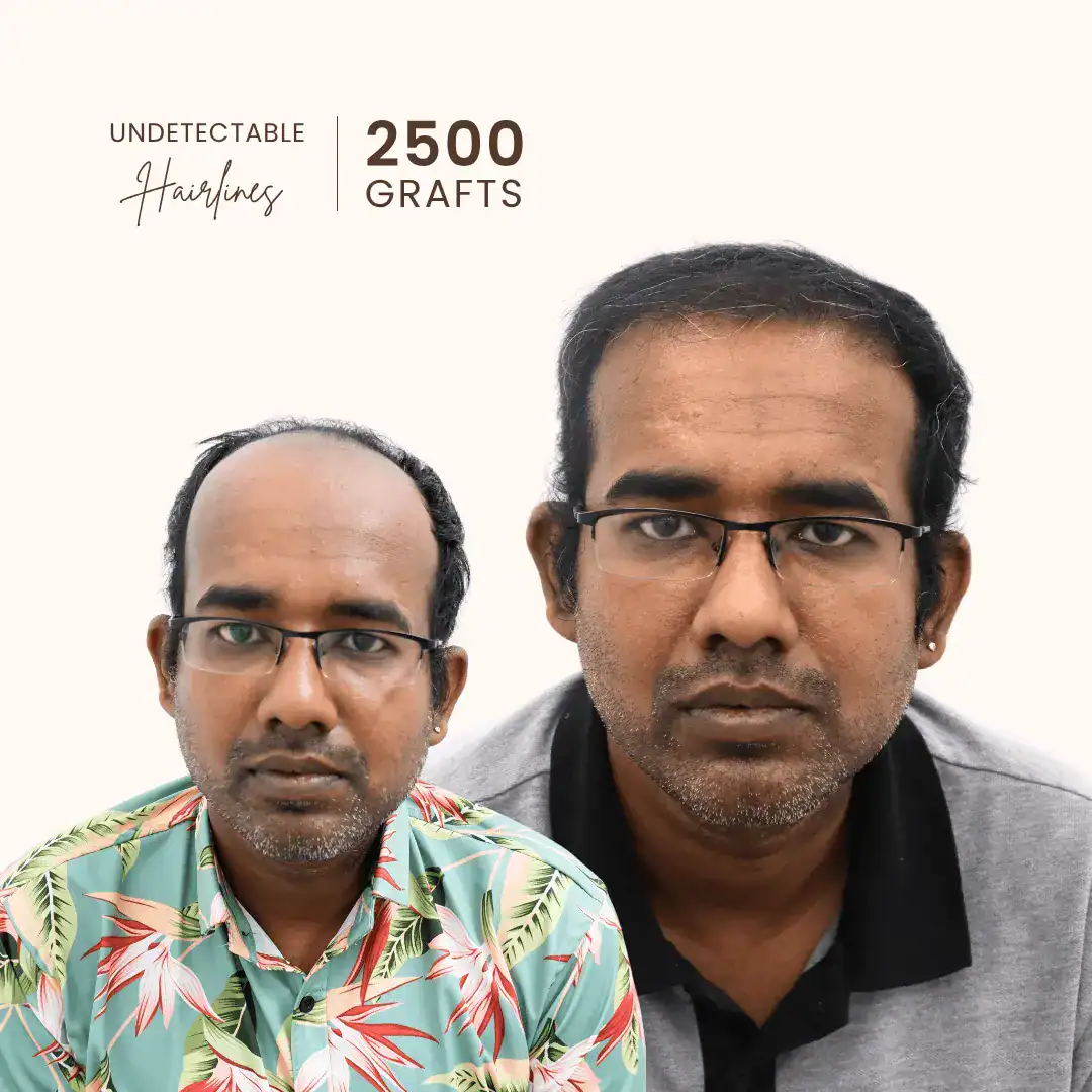 Rahul Verma hair transplant result Delhi